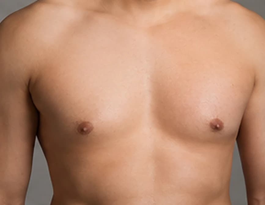 Gynecomastia Surgery (Male Breast Reduction) — a body contour in warm studio light