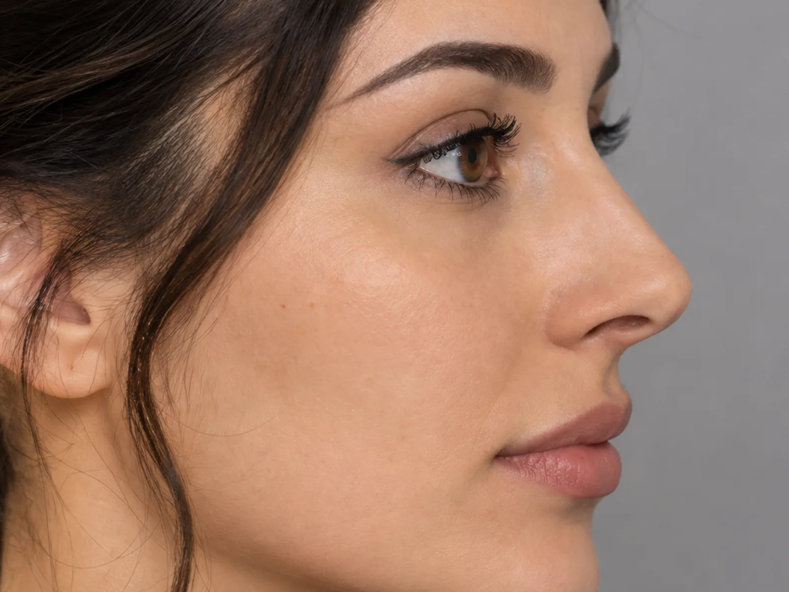 Rhinoplasty, after