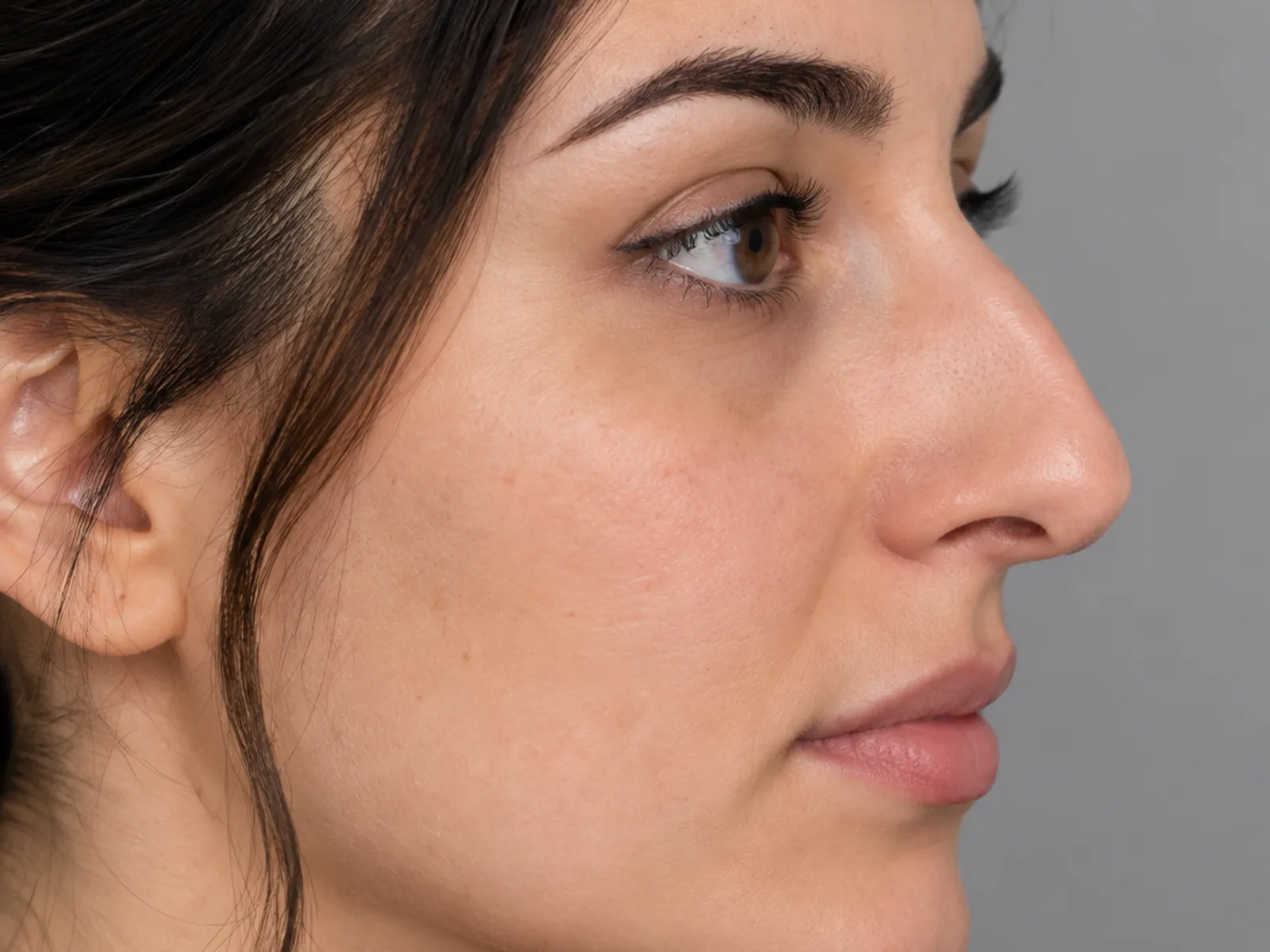 Rhinoplasty, before